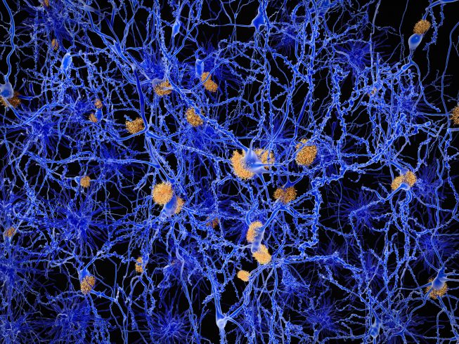 CCNA Researchers Shed Light on the Behaviour of Beta Amyloid in the Brain